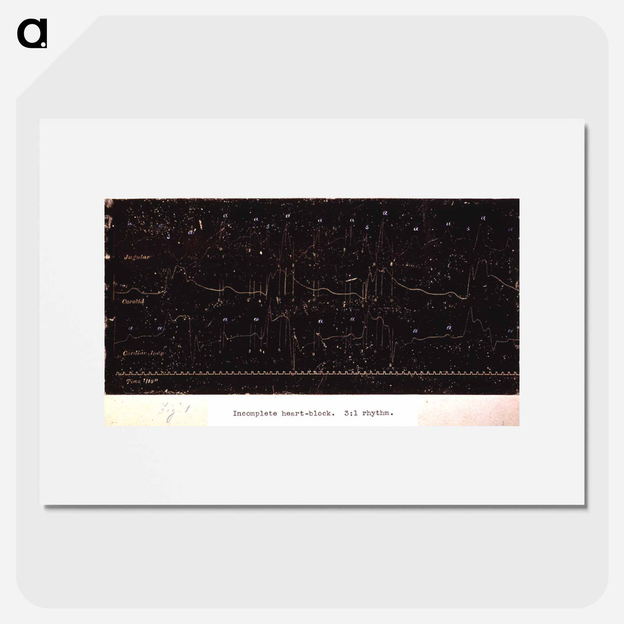 アートポスター-Electrocardiograph of Incomplete Heart Block
- 国立医学図書館 Poster.