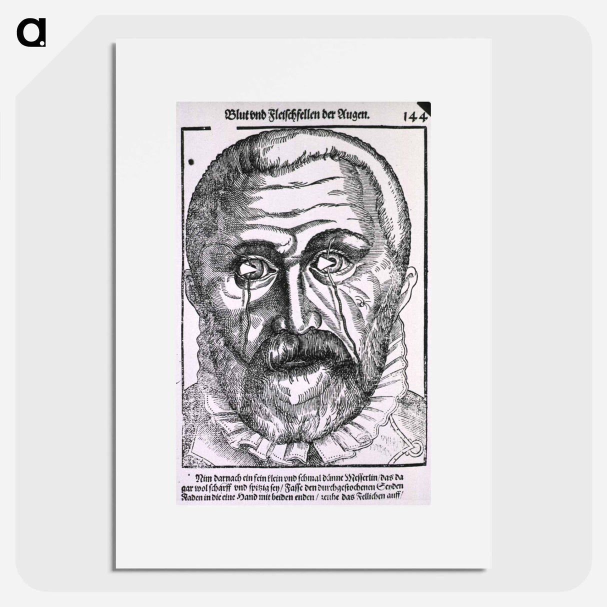 アートポスター-Surgical Treatment of Pterygium
- 国立医学図書館 Poster.