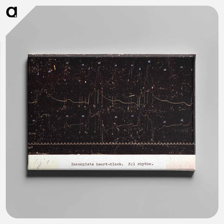 アートパネル-Electrocardiograph of Incomplete Heart Block
 - 国立医学図書館 Canvas.