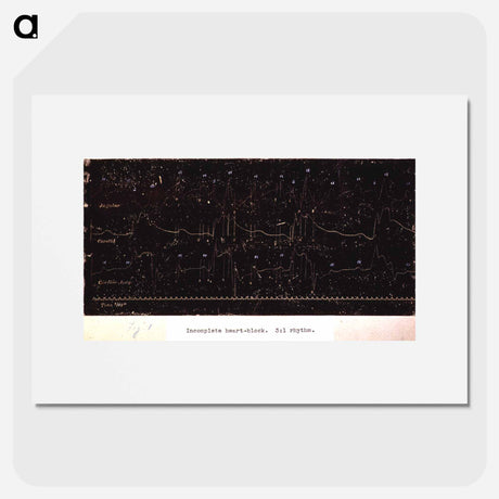 アートポスター-Electrocardiograph of Incomplete Heart Block
 - 国立医学図書館 Poster.