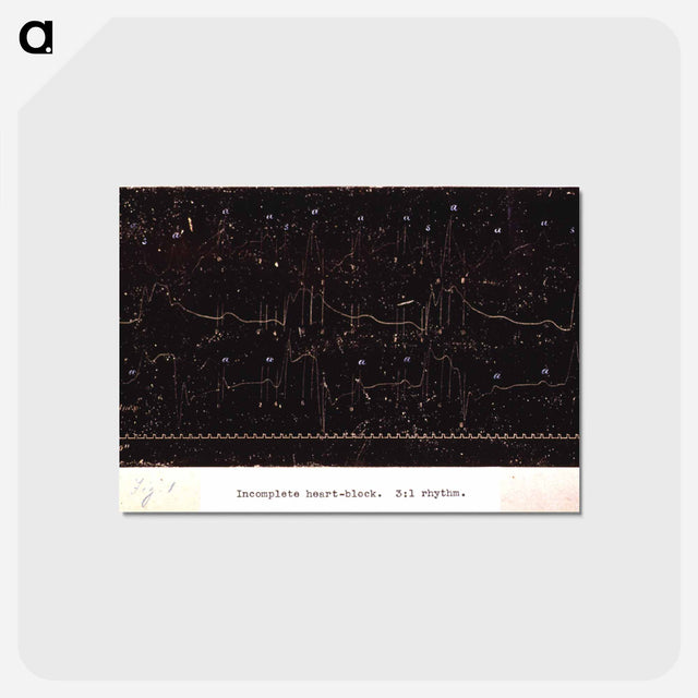 アートポストカード-Electrocardiograph of Incomplete Heart Block
 - 国立医学図書館 Postcard.