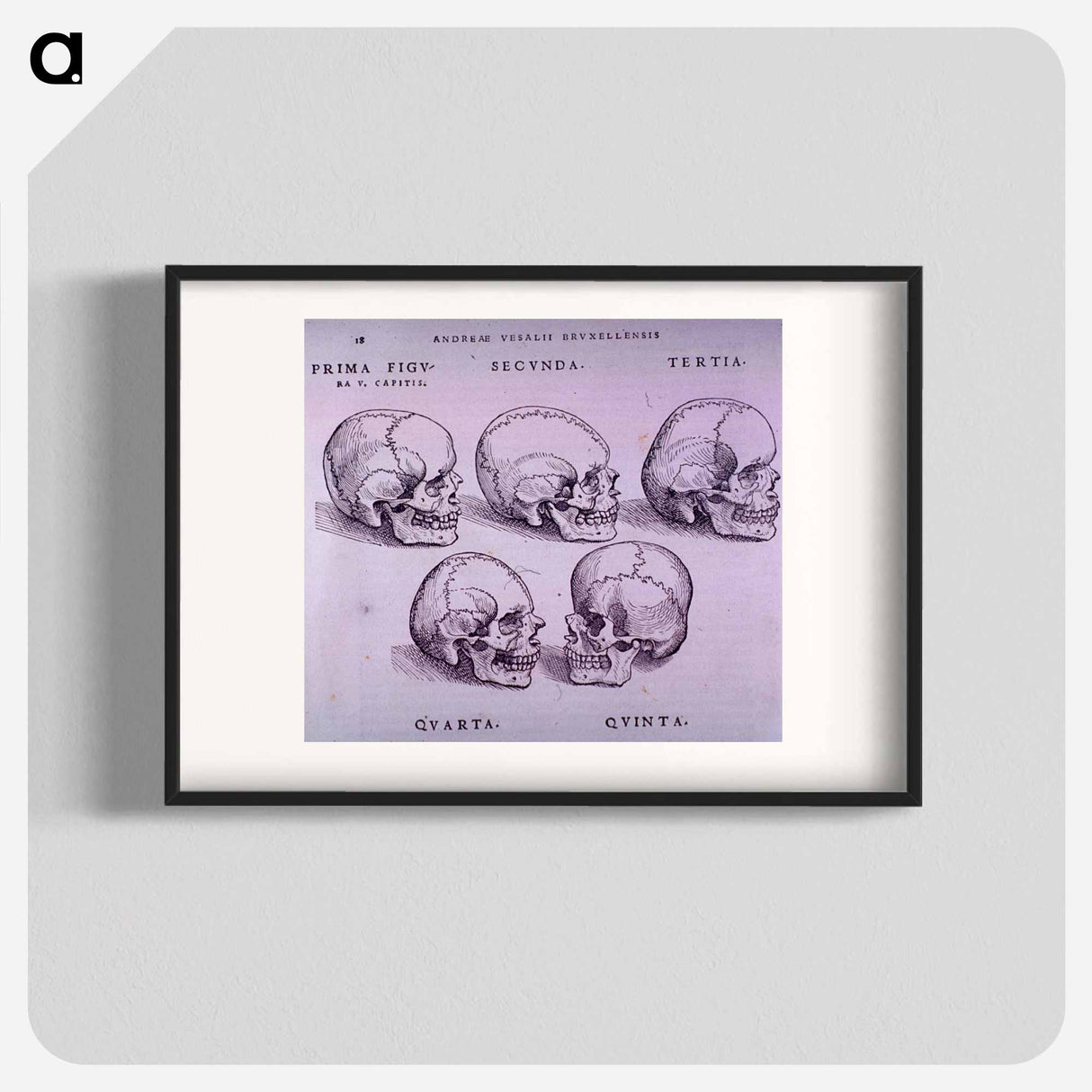 アートポスター-Bone Plate: Five Malformations of the Skull
 - 国立医学図書館 Poster.