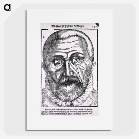 アートポスター-Surgical Treatment of Pterygium
 - 国立医学図書館 Poster.