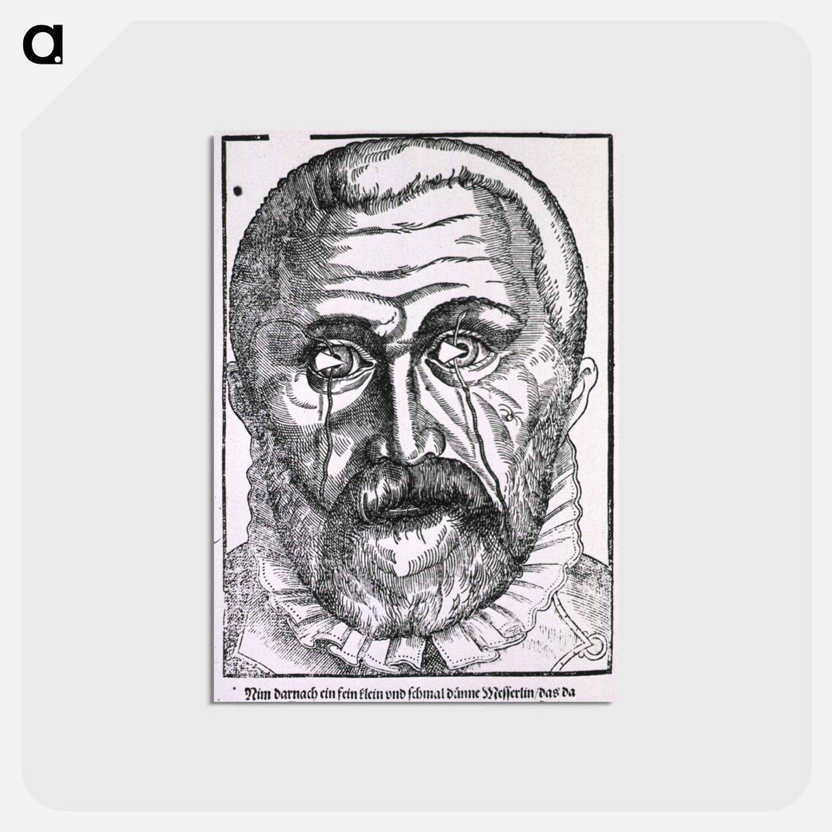 アートポストカード-Surgical Treatment of Pterygium
 - 国立医学図書館 Postcard.