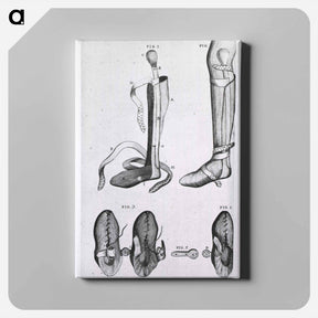 アートパネル-Leg Braces and Corrective Shoes
 - 国立医学図書館 Canvas.