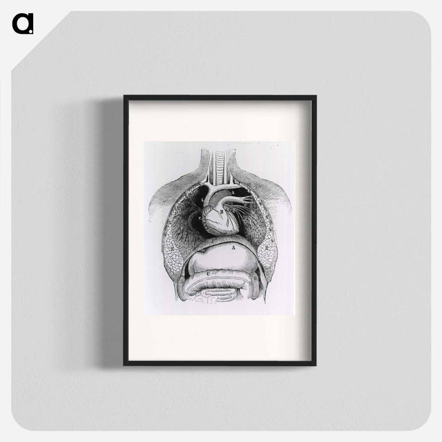 アートポスター-Distended Stomach and Colon
 - 国立医学図書館 Poster.