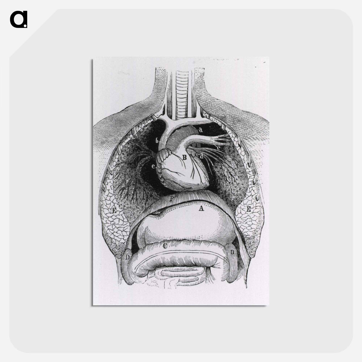 アートポストカード-Distended Stomach and Colon
 - 国立医学図書館 Postcard.